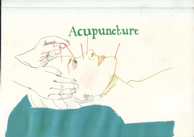 Acupuncturesml